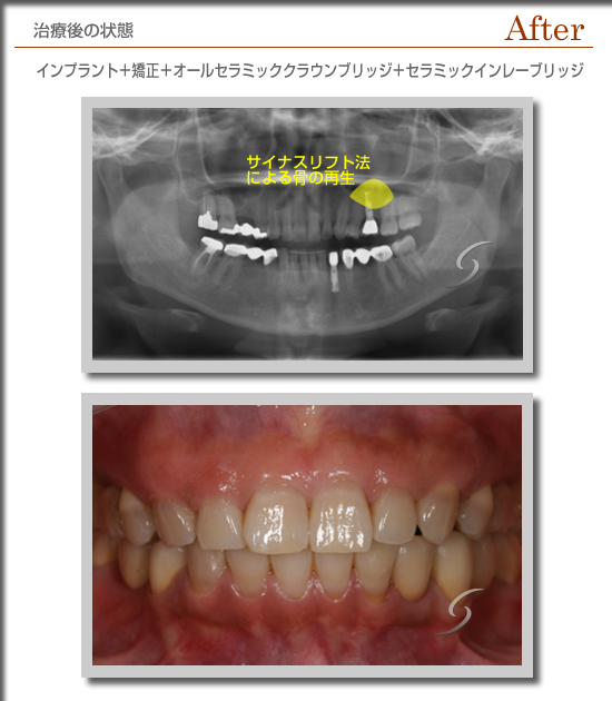 症例インプラントサイナスリフトafter.png