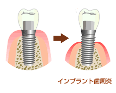 implant_guragura.gif